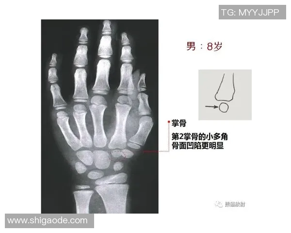 篮球明星的骨龄与职业生涯表现的关系探讨及对年轻球员发展的启示